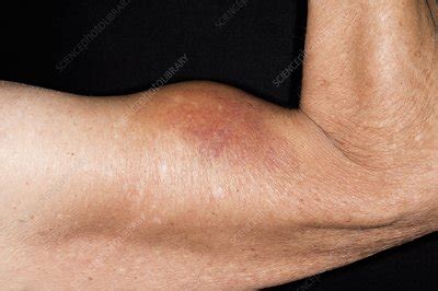 Torn biceps muscle in the arm - Stock Image - C009/0136 - Science Photo Library