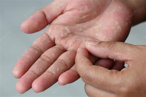 These serious reasons can be behind the peeling of the skin on the hands; Know the right ...