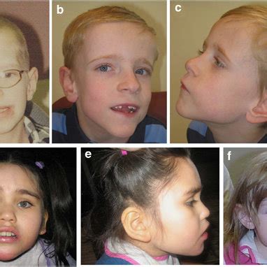 Subject 1 at 10 years. Note frontal bossing, bifrontal narrowing,... | Download Scientific Diagram