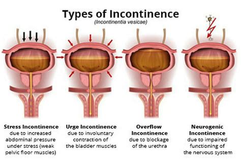 Bladder dysfunction - Life Physio