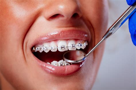 Is It Safe to Use Teeth Whitening While Wearing Braces? | Peel Dental Studio Dentist Mandurah