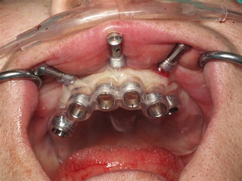 Why it is some sort of Good Idea to Have Dental Implants in Another Country? – myorchard.net