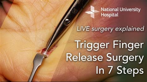 LIVE Surgery Explained: Trigger Finger Release Surgery in 7 Steps - YouTube