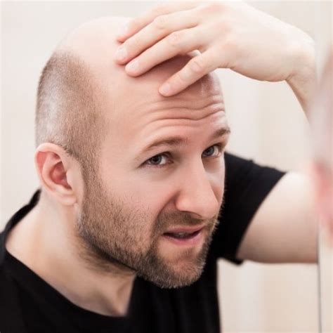 Going Bald Too Young? This is How to Prevent Hair Loss! | MOREWOWNOW