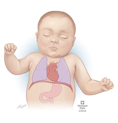 Congenital Diaphragmatic Hernia Patient Education (CC) on Behance