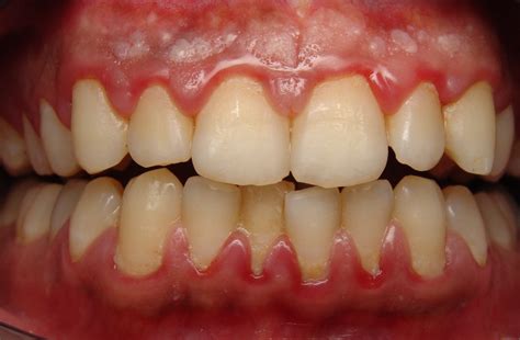 Gum Disease - How can I tell? - Cranbourne North Dental