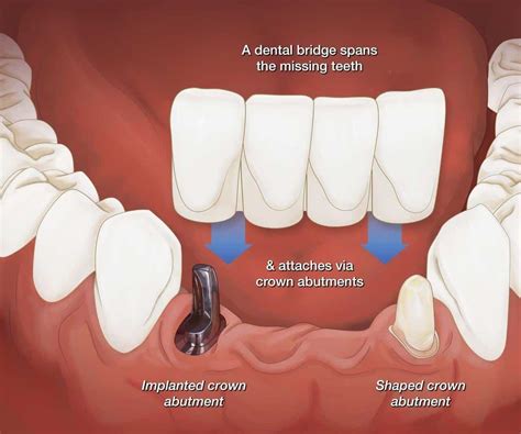 Dental Bridge Abutment