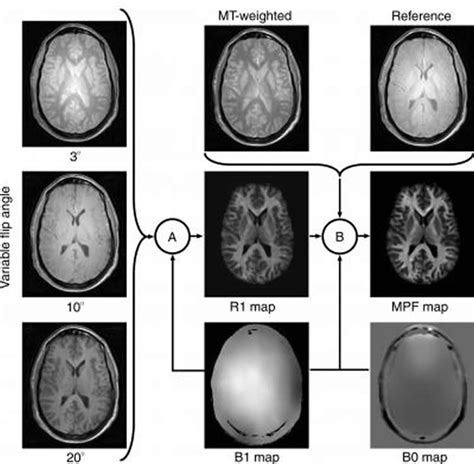 MRI Shows Gray Matter Myelin Loss Strongly Related to MS Disability - Neuroscience News