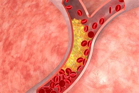 National Cholesterol Education Month - Men's Health Network