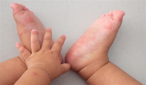 Mild Hand Foot And Mouth Disease Adult