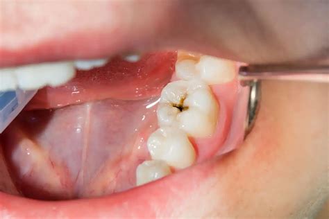 Wait, Can Cavities Go Away on Their Own?