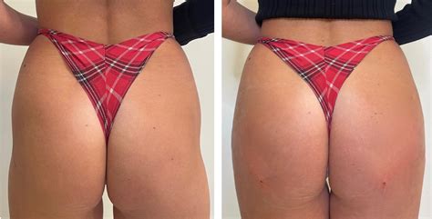 Non-Surgical BBL in Vienna | Brazilian Butt Lift | Aura Medspa