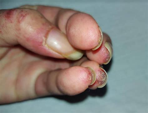 Clinical Challenge: Diffuse Rash Affecting Fingertips - MPR