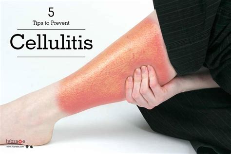 5 Tips to Prevent Cellulitis - By Dr. Rameshwar Madhukar Rao Gutte | Lybrate