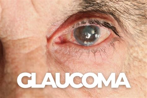 What's the First Sign Of Glaucoma? - EZOnTheEyes