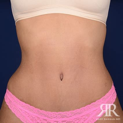 Belly button discharge after tummy tuck - Cosmetic Surgery Tips