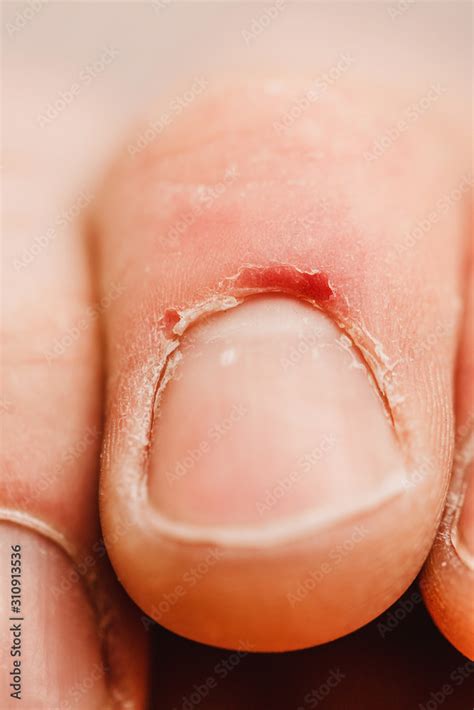 Damaged cuticle on the finger - cracks and dry skin - not groomed nails Stock Photo | Adobe Stock