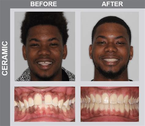 Smile Gallery | Before and Afters | NCOSO Orthodontics