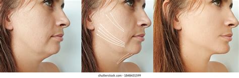 Double Chin Women Before After Treatment Stock Photo 1849116730 | Shutterstock