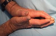 Diabetic cheiroarthropathy - Wikipedia