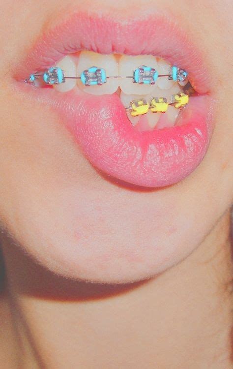 10 Braces ideas | braces, braces tips, brace face