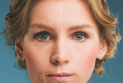 BOTOX Madison WI: What Exactly Does Botox Do? - Madison Medispa