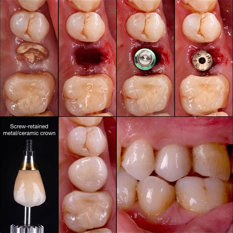 🇬🇧Immediat implant placement after the extraction of hopeless second premolar. Screw-retained ...