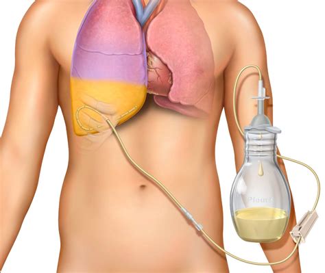 PleurX™ Catheter System resources for Healthcare Professionals - BD