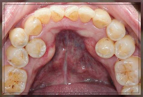 Hyperdontia Causes, Symptoms and Treatment - Dentist Ahmed