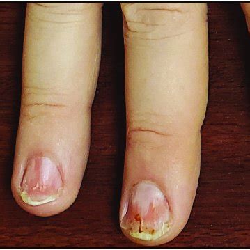 Diffuse onychoptosis involving all fingernails | Download Scientific ...