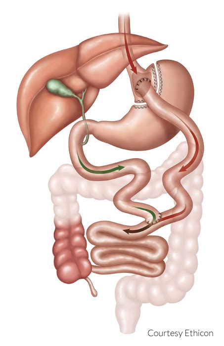 Gastric Bypass (Roux-en-Y) Long Island, New York