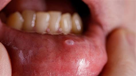 Oral Mucocele Cysts: Symptoms, Causes, and Treatment