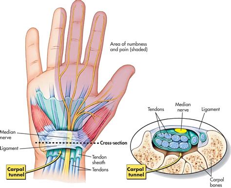 Carpal Tunnel Syndrome Explained