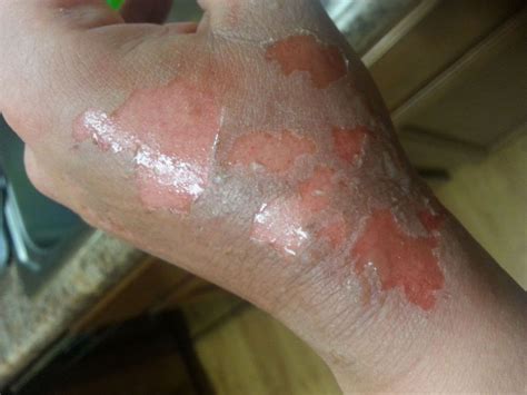 2nd-Degree Burns: Photos, Causes, Treatment