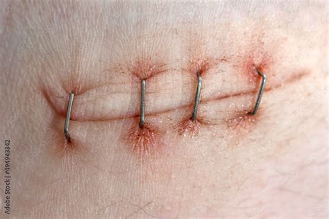 Foto de Surgical staples for sutures to close skin. First aid for a deep cut on the skin ...