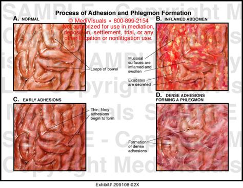 Medivisuals Process of Adhesion and Phlegmon Formation Medical Illustration