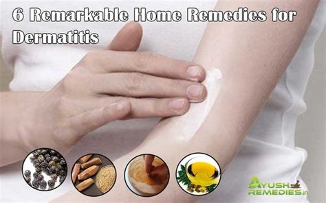 6 Home Remedies for Dermatitis on Face, Scalp and Hands