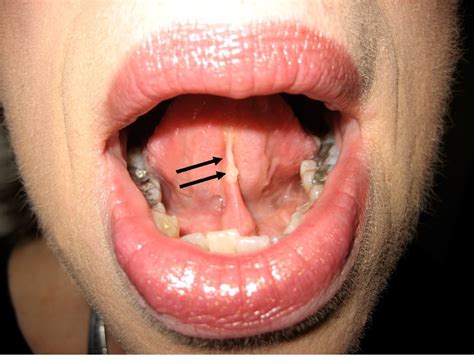 An Atlas of Lingual Lesions, Part 3 | Consultant360