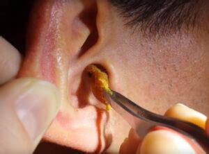 Ear Wax Removal - ENT Specialists of South Florida