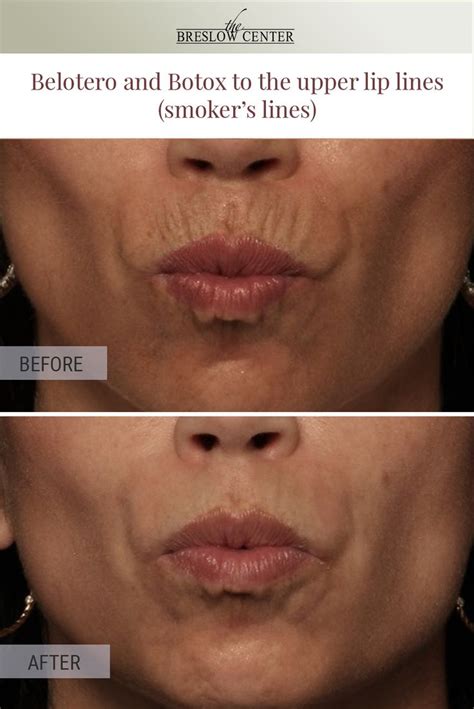 Procedure: Belotero and Botox to the upper lip lines (smoker’s lines). Dr. Breslow and Dr ...