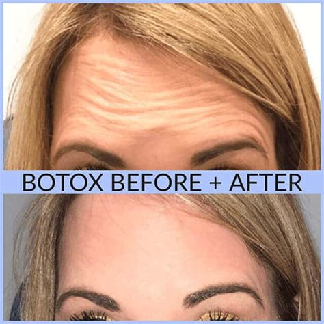 Botox Side Effects Forehead