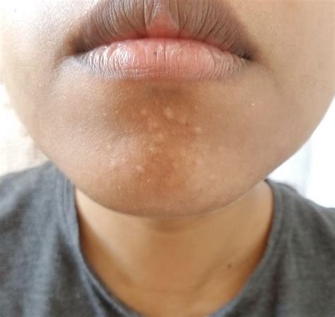 What are these bumps on my chin? Please help : r/DermatologyQuestions