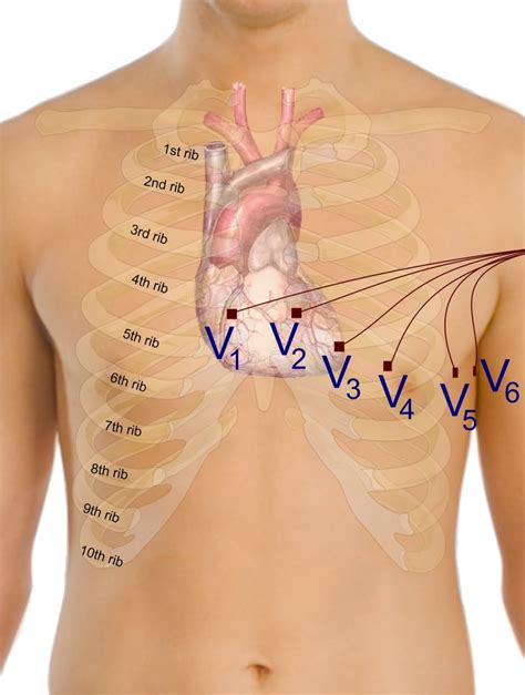 12 Lead Ecg Placement Color Coded