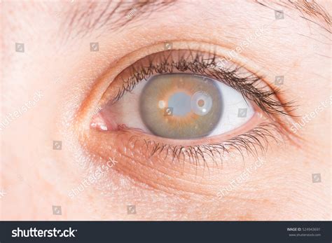 Blindness One Eye Stock Photo 524943691 | Shutterstock