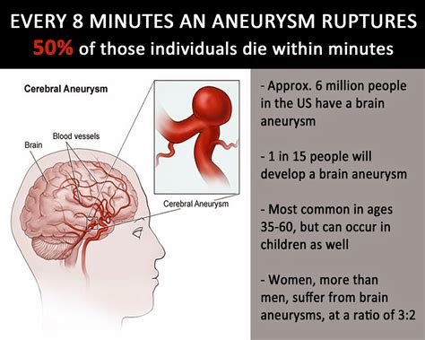 If You Ever...: Brain Aneurysms