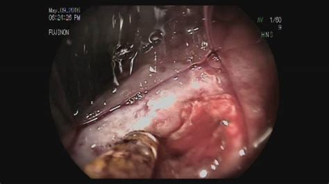 Bleeding Ulcer at Small Bowel Anastomosis - YouTube