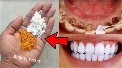 Teeth whitening and scaling at home in 1 minute, you will get pearl white teeth - YouTube