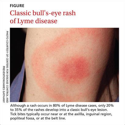 Bulls Eye Tick Bite Rash Dog - Infoupdate.org