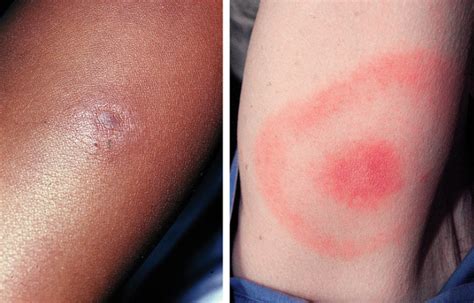 Lyme Disease Rash – 𝗗𝗜𝗔𝗚𝗡𝗢𝗦𝗜𝗦 𝟭𝟮𝟯