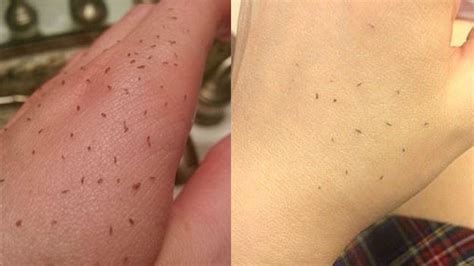 "Skin Gritting" Is Blackhead Removal Like You've Never Seen Before | Teen Vogue